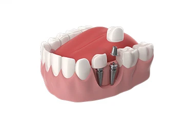 Dental Implant Offer banner