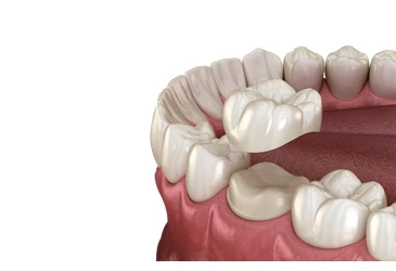 Zirconium Crowns Offer banner