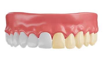 Teeth Whitening Offer banner